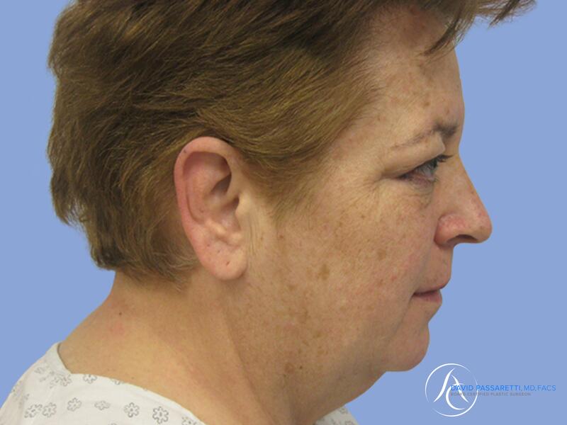 Facelift before & after photo