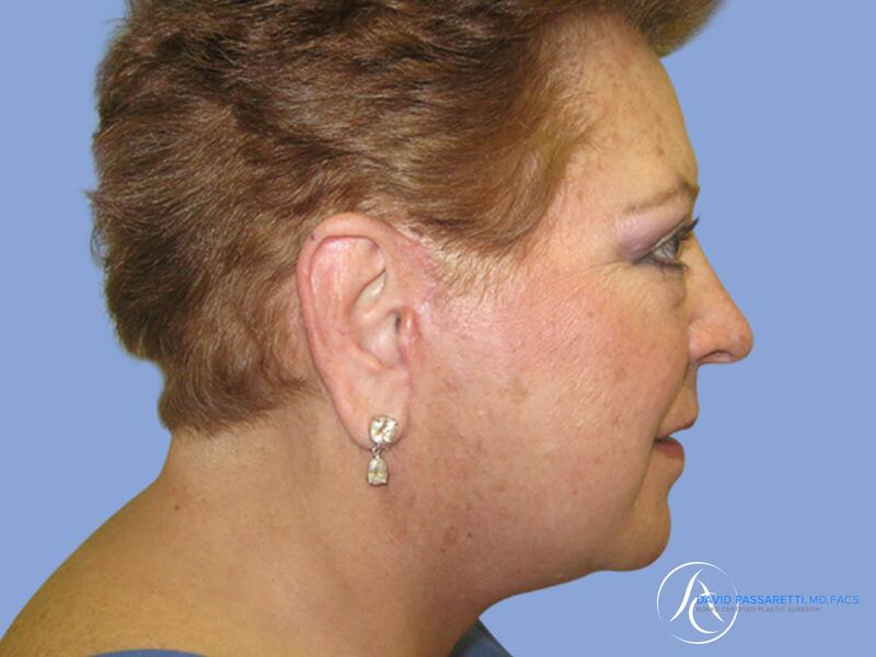 Facelift before & after photo