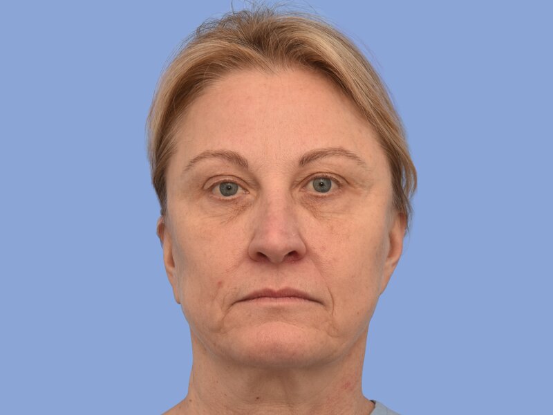 Facelift before & after photo