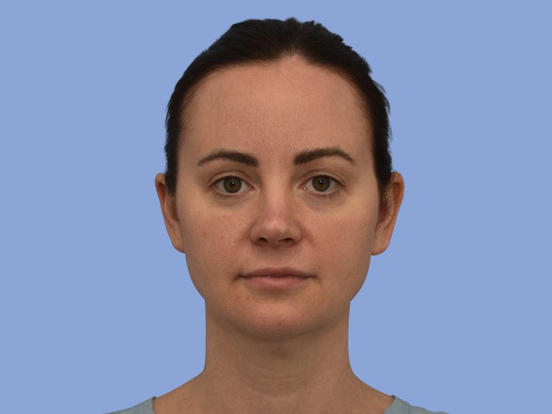 Facelift before & after photo