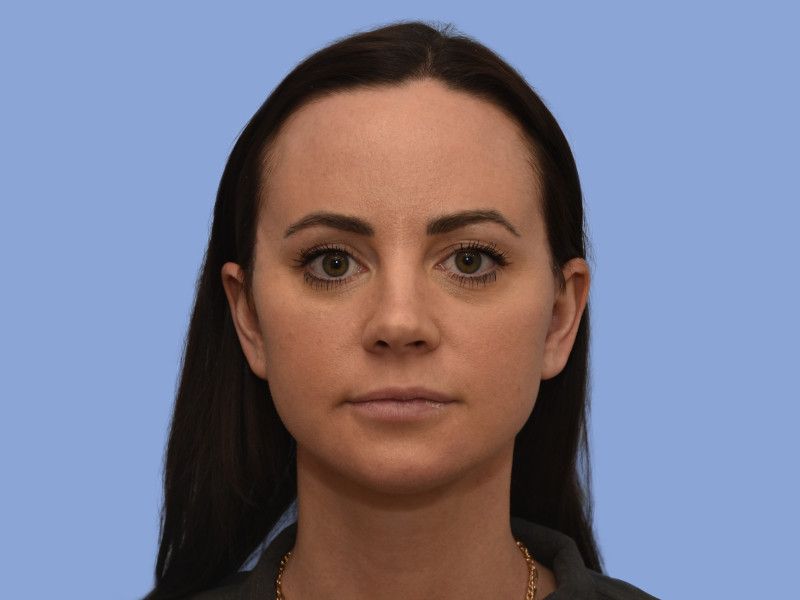Facelift before & after photo