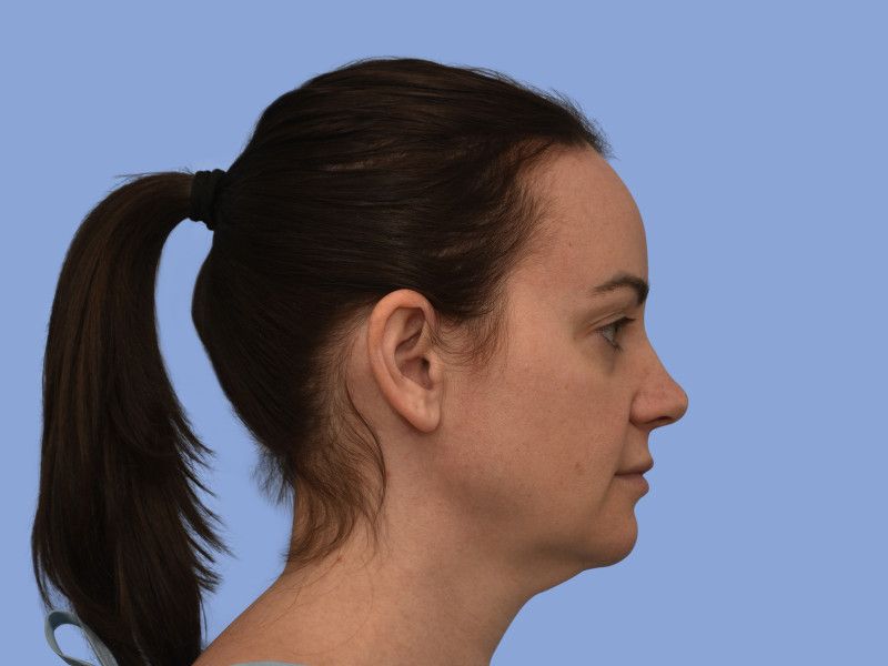 Facelift before & after photo