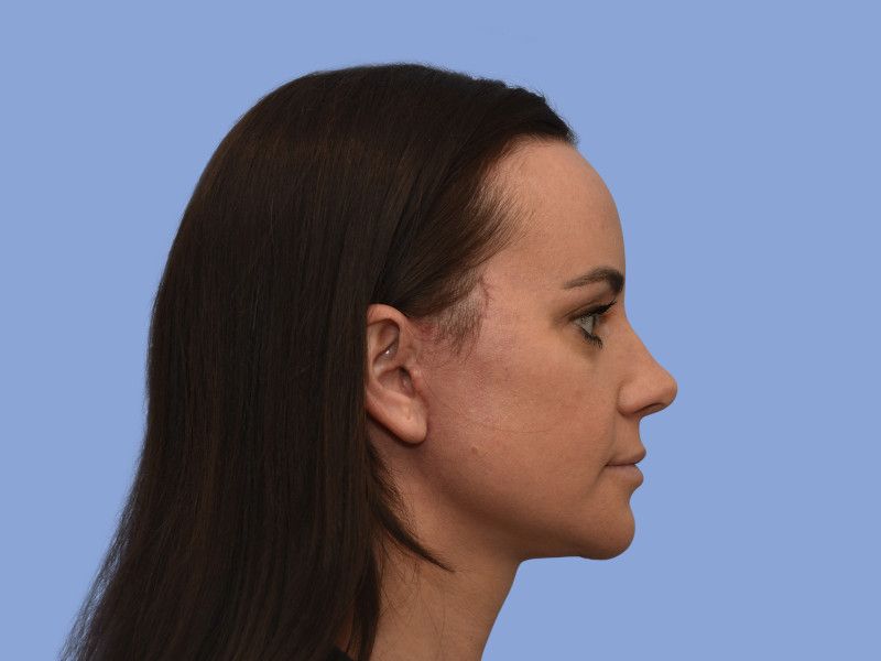 Facelift before & after photo