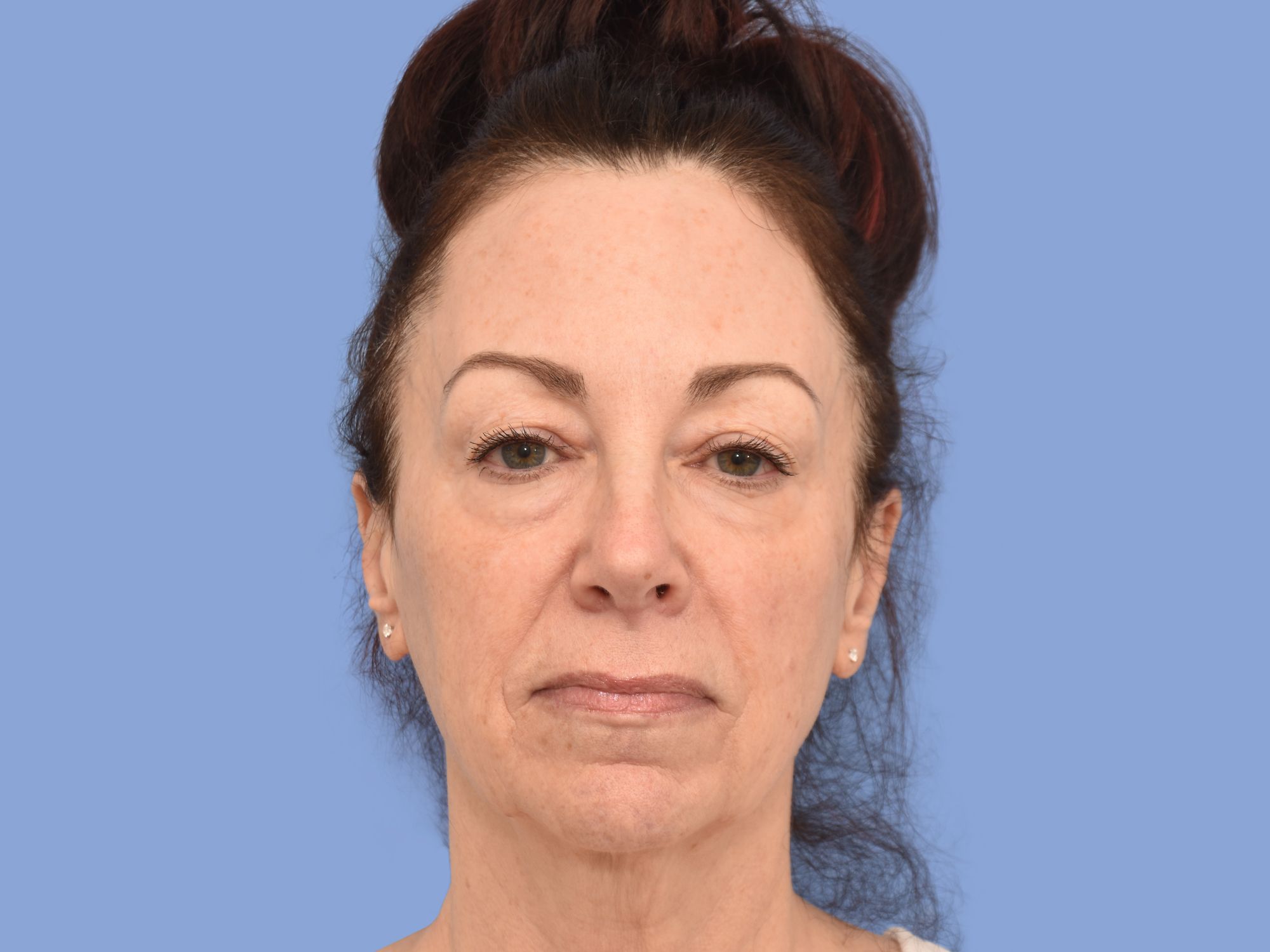 Facelift before & after photo