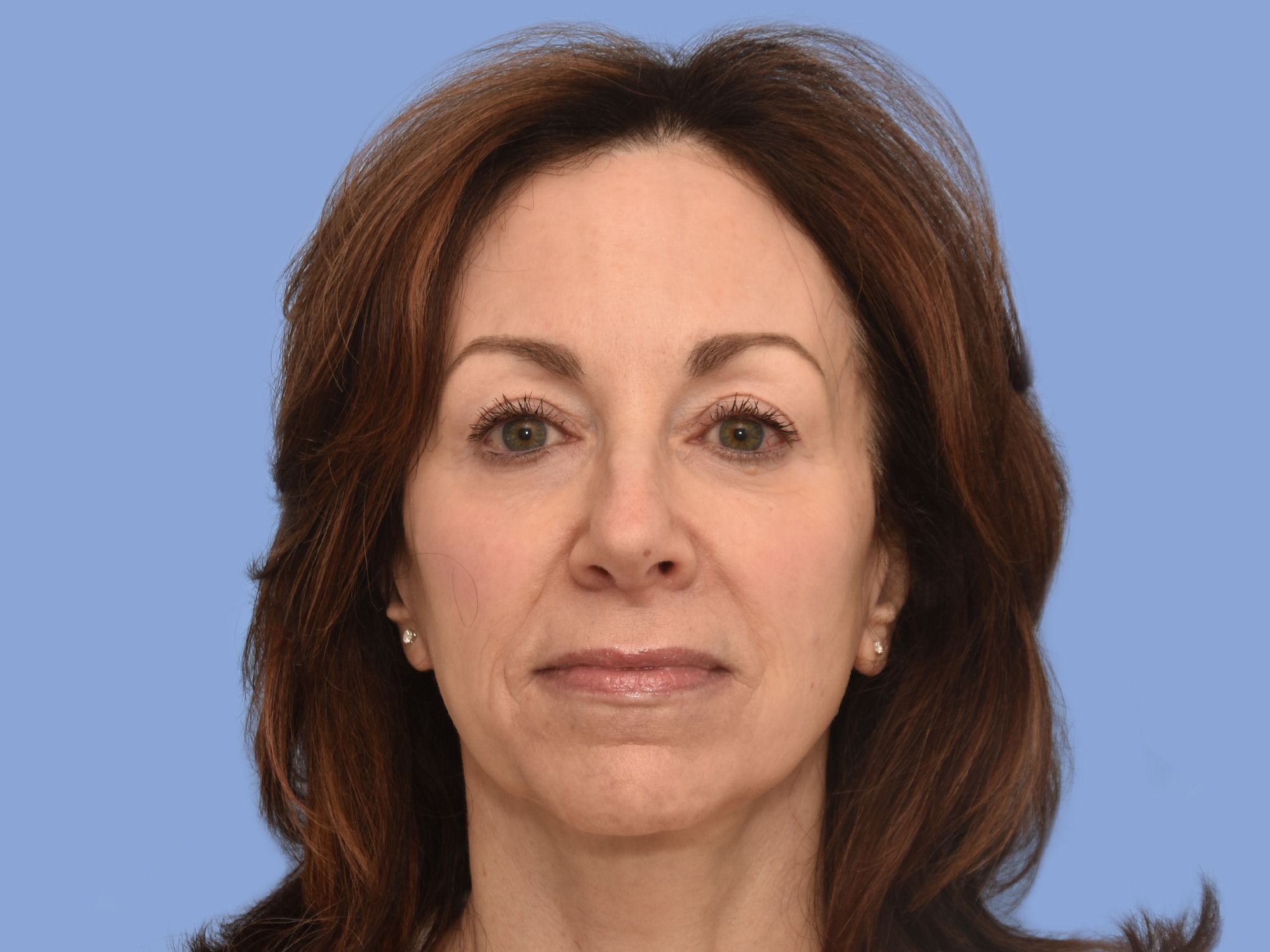 Facelift before & after photo