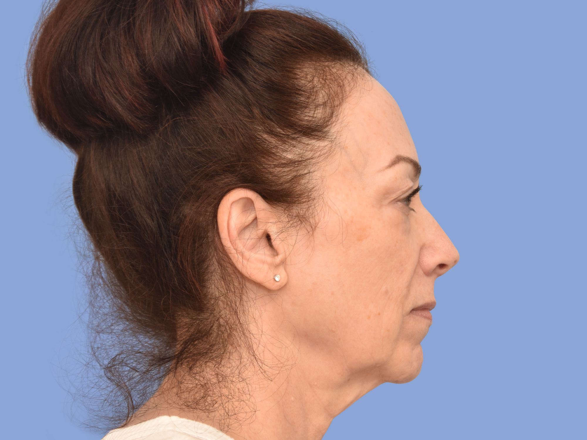 Facelift before & after photo