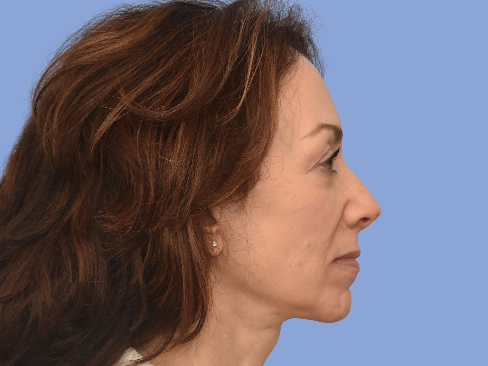 Facelift before & after photo