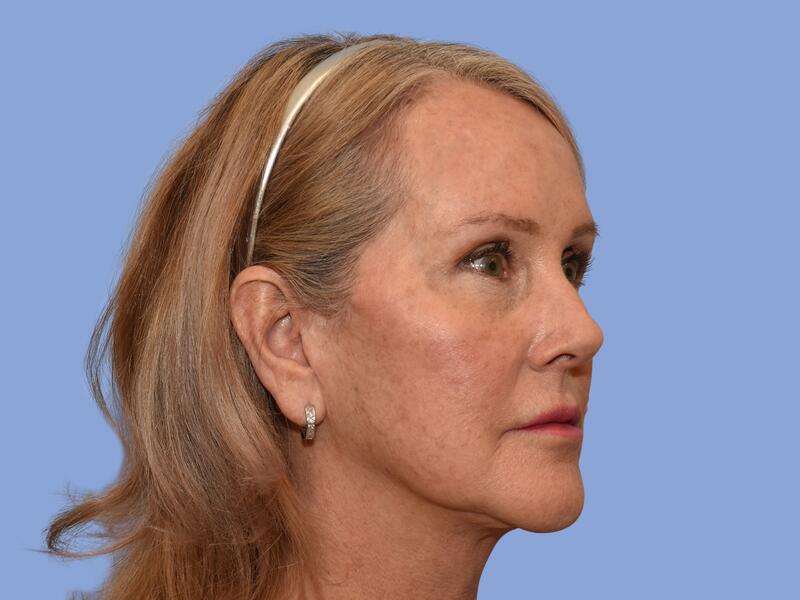 Neck lift before & after photo