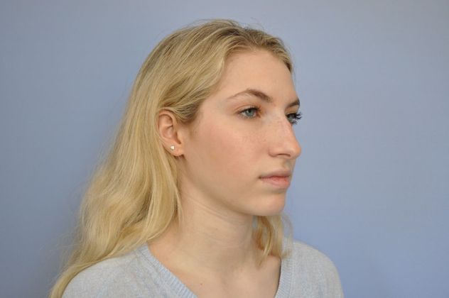 Rhinoplasty before & after photo
