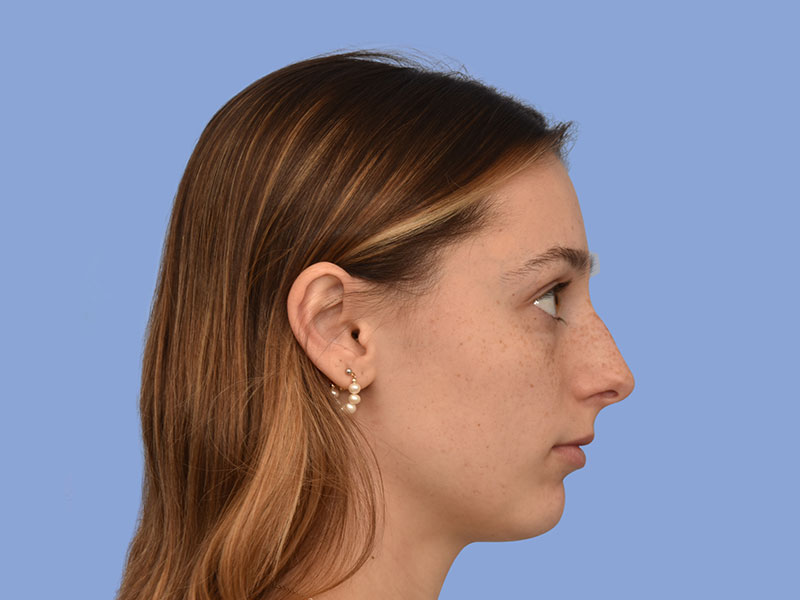 Rhinoplasty before & after photo