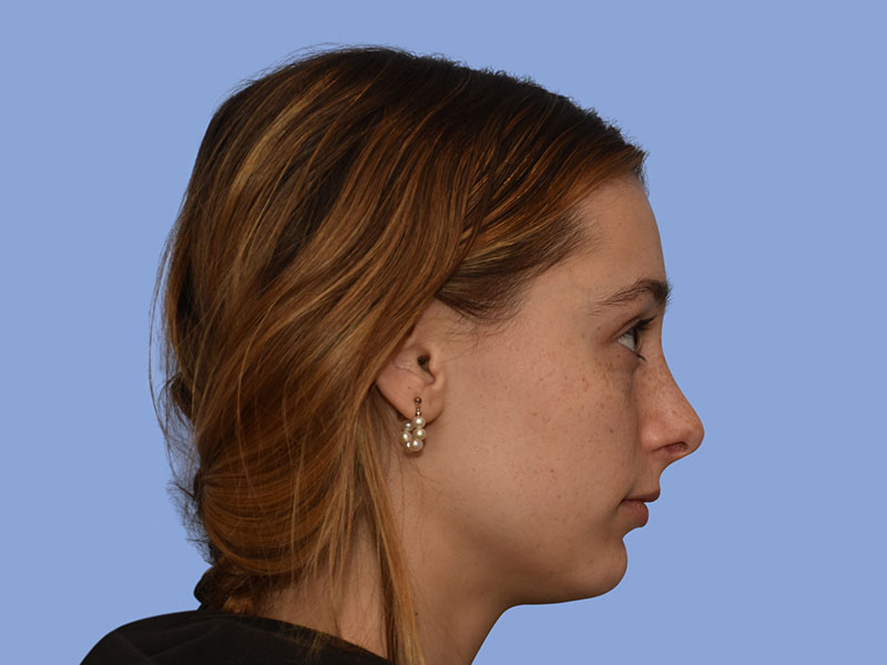 Rhinoplasty before & after photo