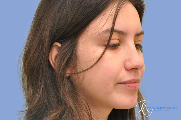 Rhinoplasty before & after photo