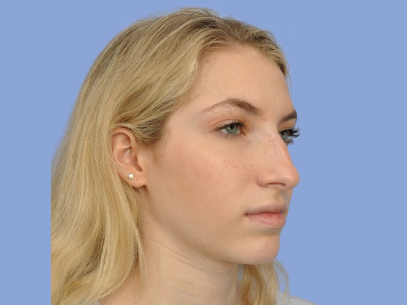 Rhinoplasty before & after photo
