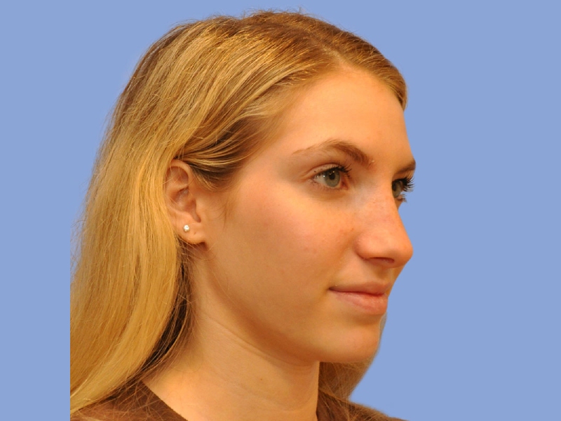 Rhinoplasty before & after photo