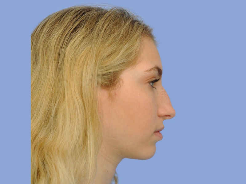 Rhinoplasty before & after photo