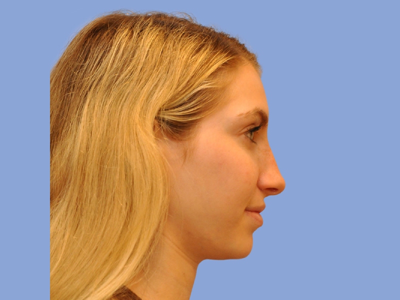 Rhinoplasty before & after photo