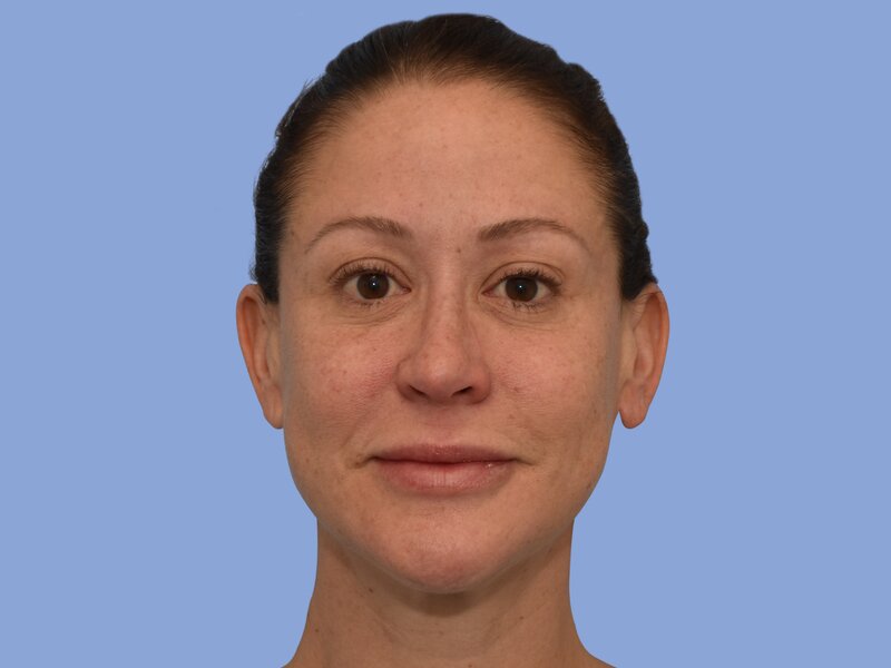 Rhinoplasty before & after photo