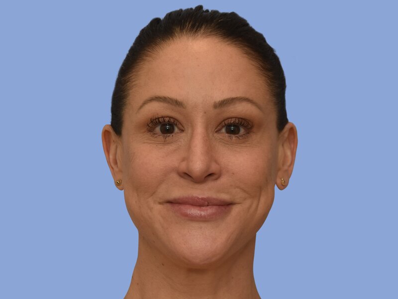Rhinoplasty before & after photo