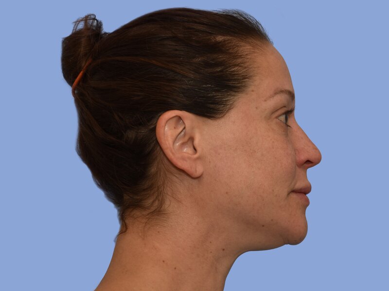 Rhinoplasty before & after photo