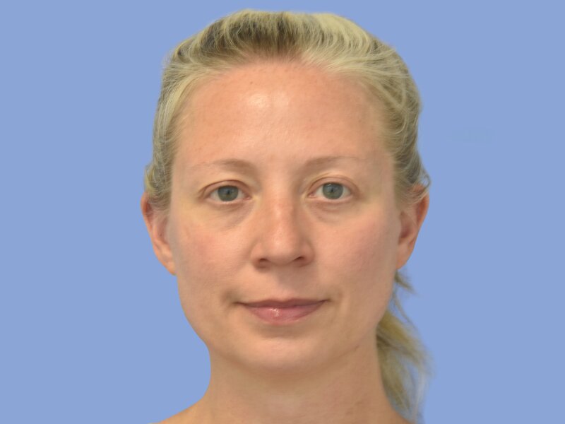 Rhinoplasty before & after photo