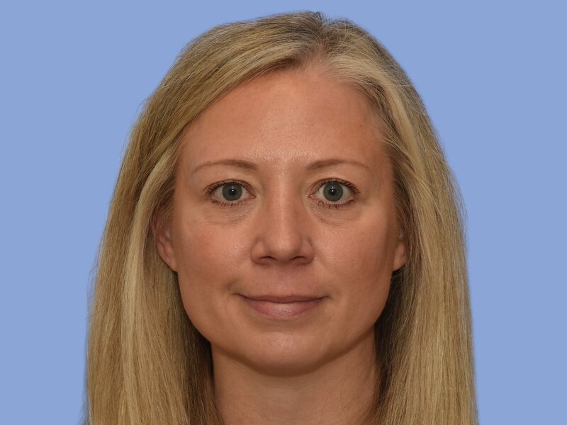 Rhinoplasty before & after photo