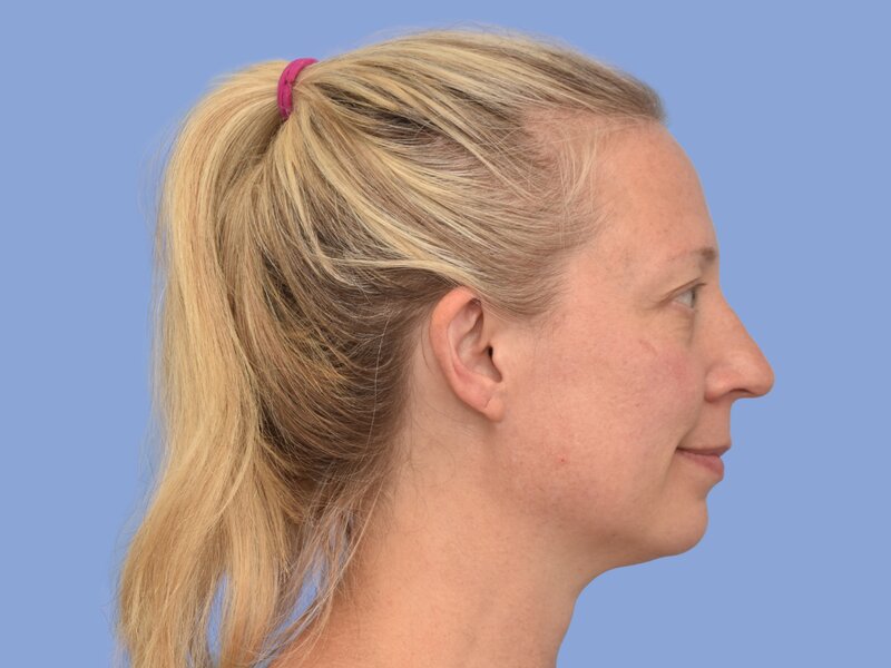 Rhinoplasty before & after photo