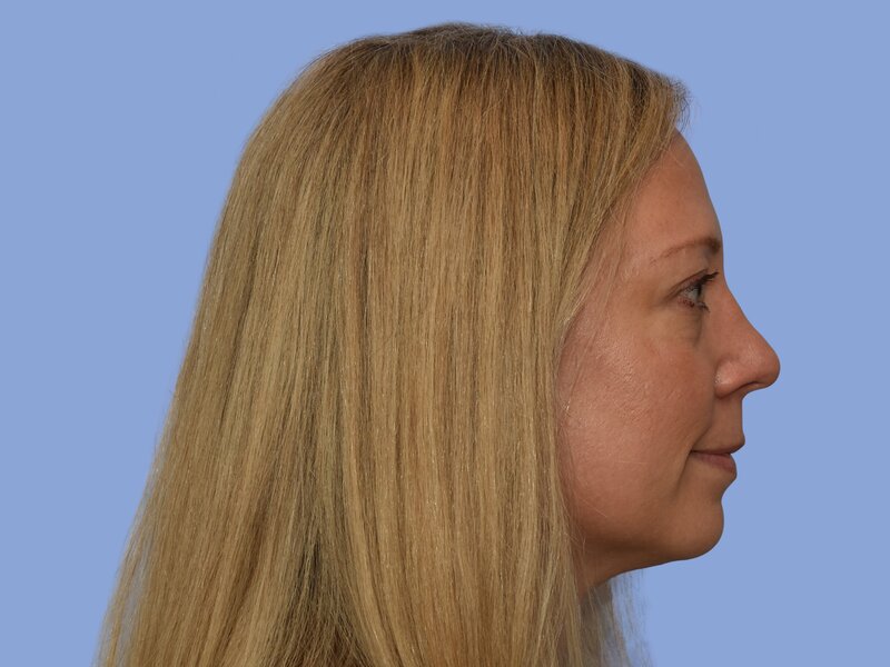 Rhinoplasty before & after photo