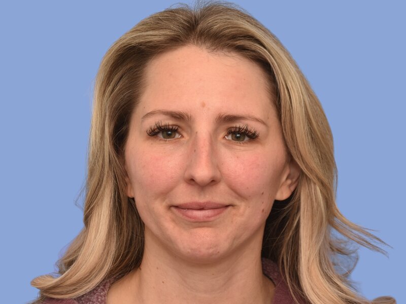 Rhinoplasty before & after photo