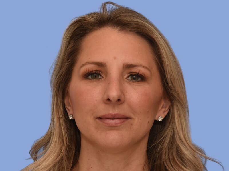 Rhinoplasty before & after photo