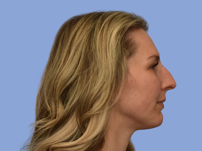 Rhinoplasty before & after photo