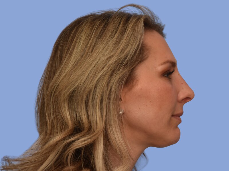 Rhinoplasty before & after photo