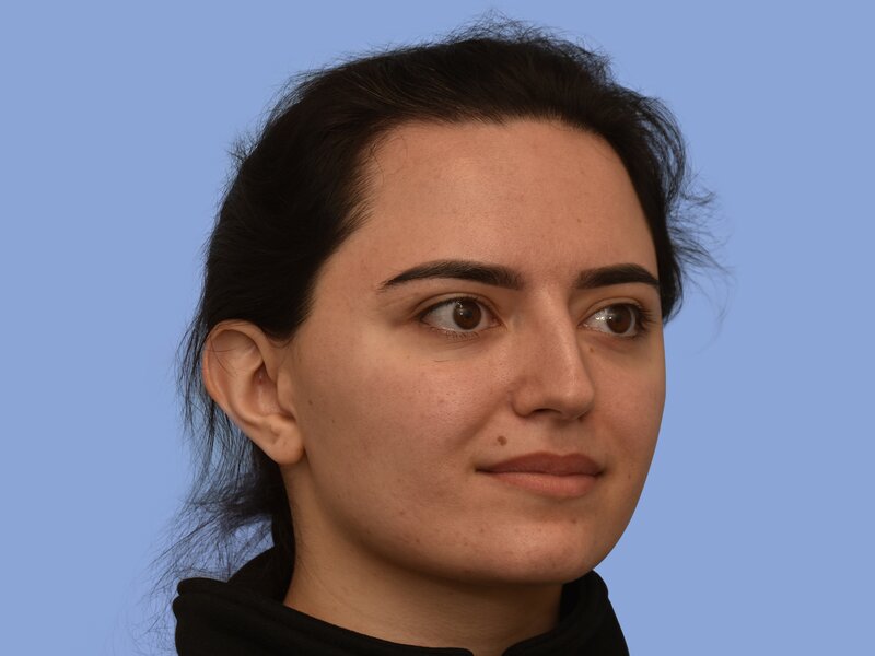 Rhinoplasty before & after photo