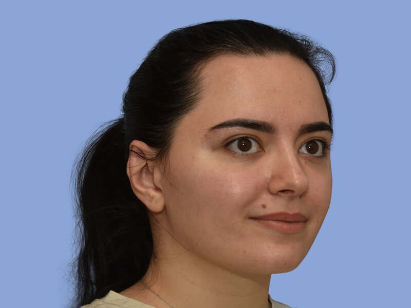 Rhinoplasty before & after photo