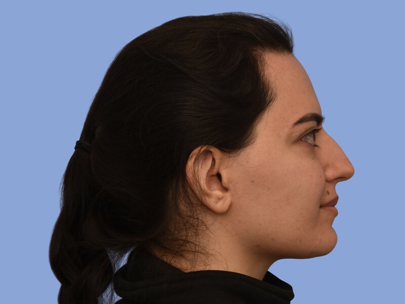 Rhinoplasty before & after photo