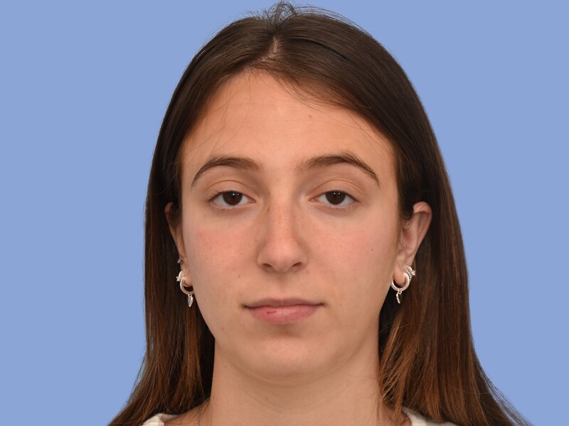 Rhinoplasty before & after photo