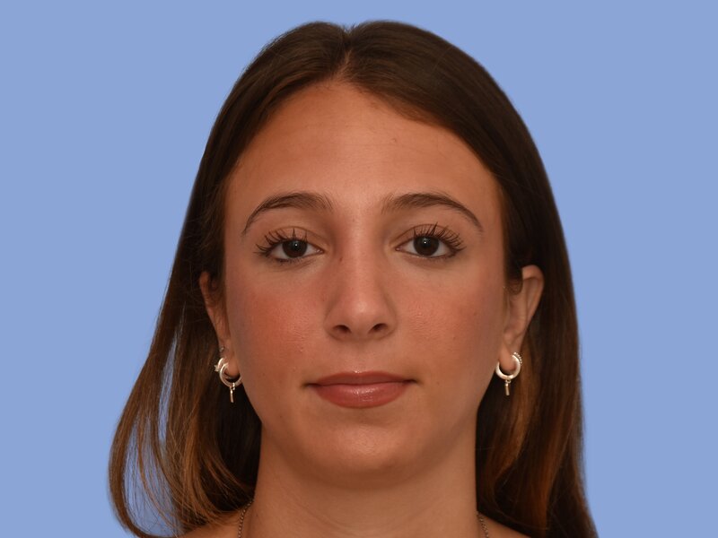 Rhinoplasty before & after photo