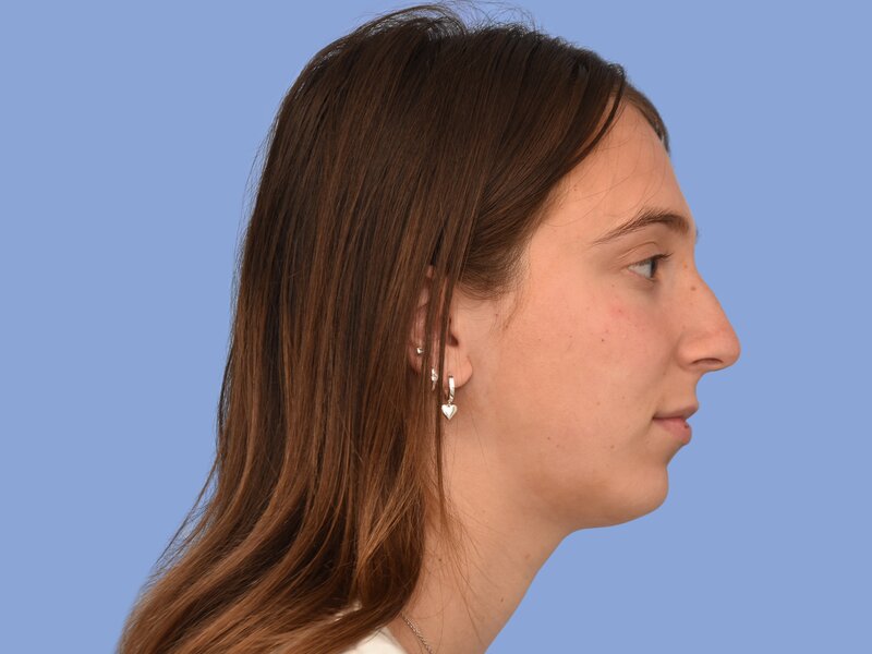 Rhinoplasty before & after photo