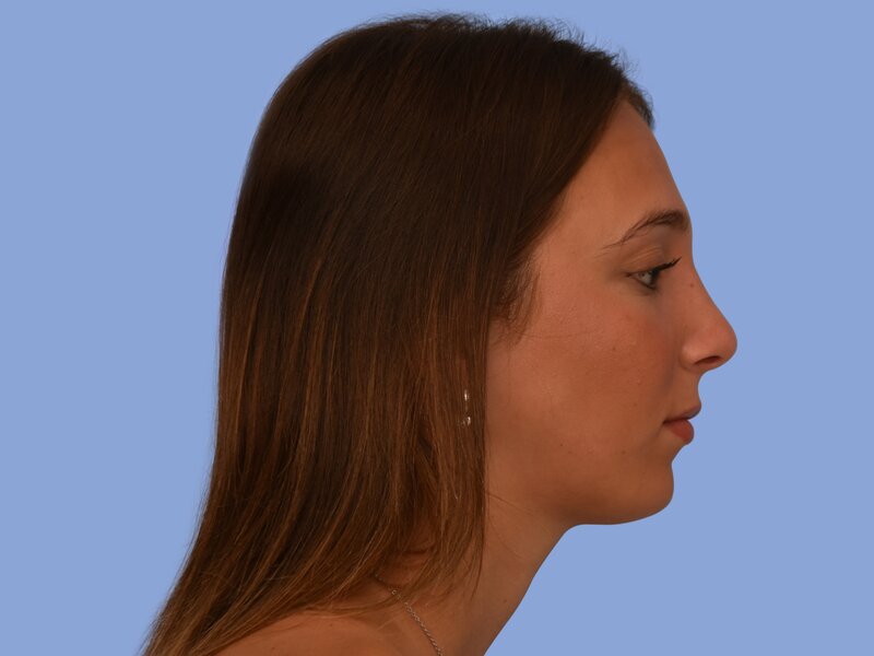 Rhinoplasty before & after photo