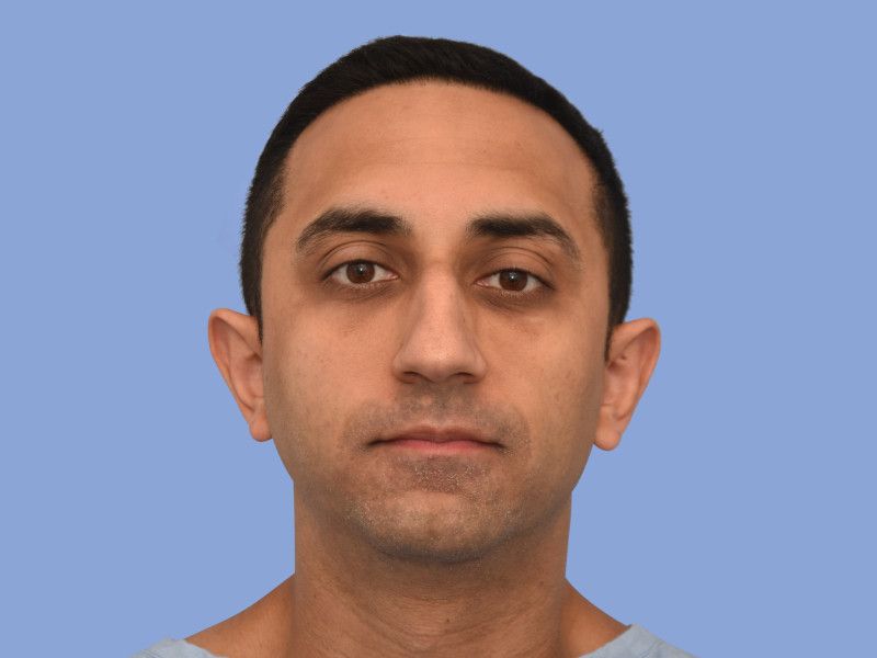 Rhinoplasty before & after photo