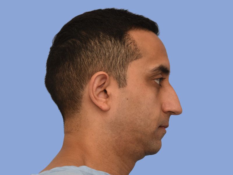 Rhinoplasty before & after photo