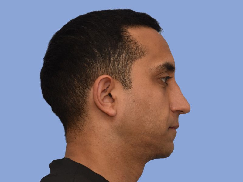 Rhinoplasty before & after photo