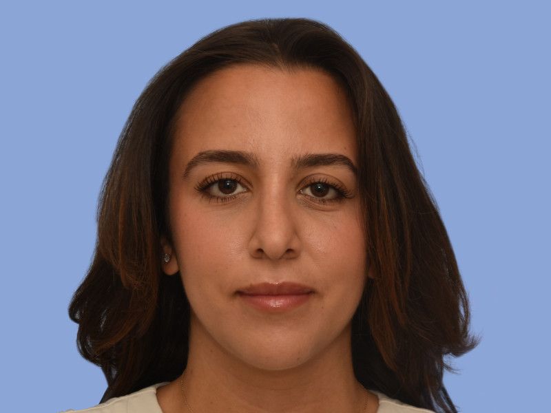 Rhinoplasty before & after photo