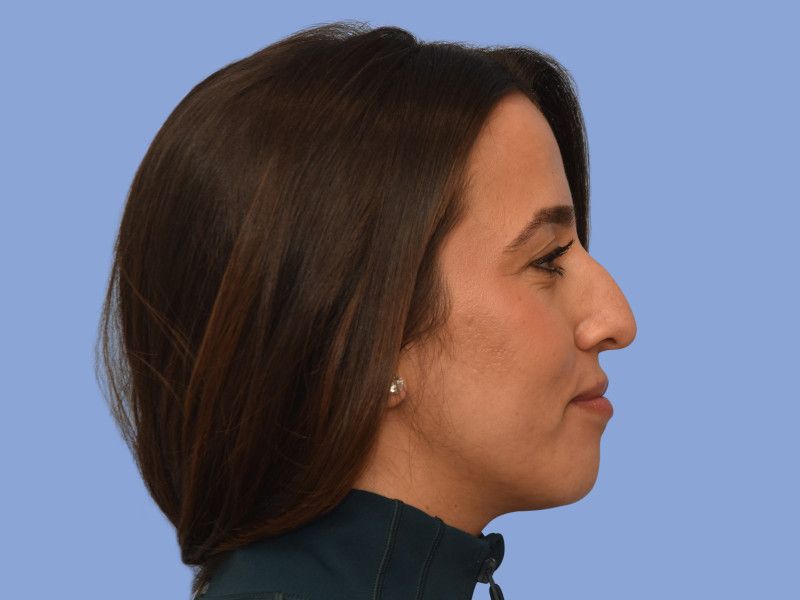 Rhinoplasty before & after photo