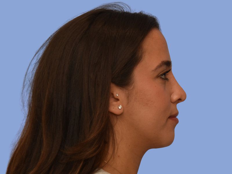 Rhinoplasty before & after photo