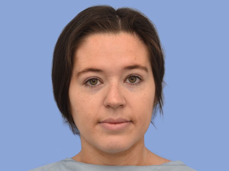 Rhinoplasty before & after photo