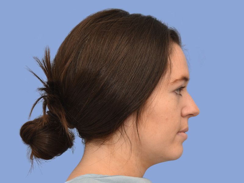 Rhinoplasty before & after photo