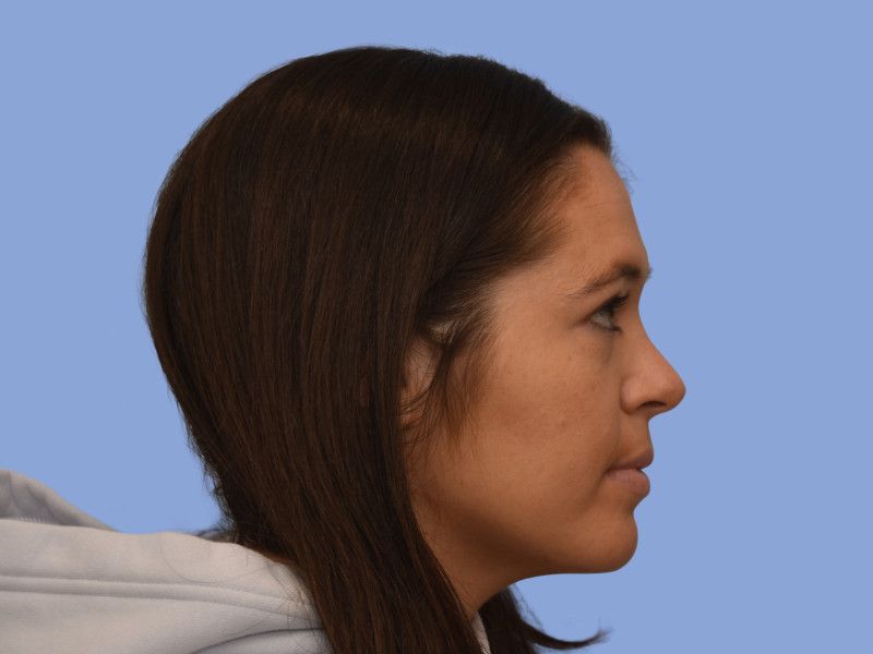 Rhinoplasty before & after photo
