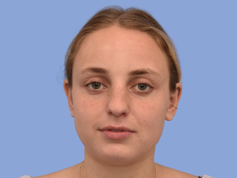 Rhinoplasty before & after photo