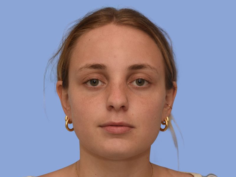 Rhinoplasty before & after photo