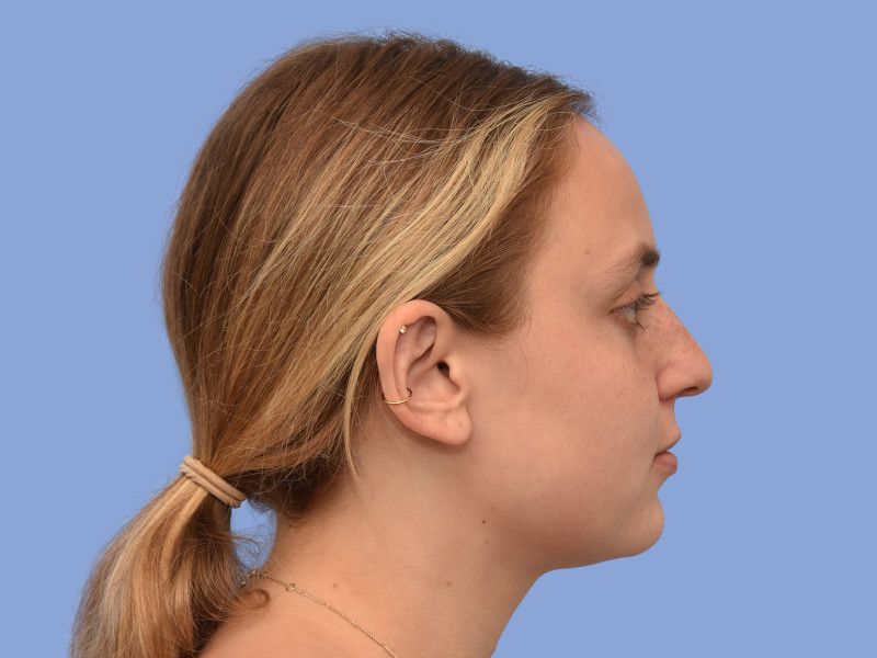 Rhinoplasty before & after photo